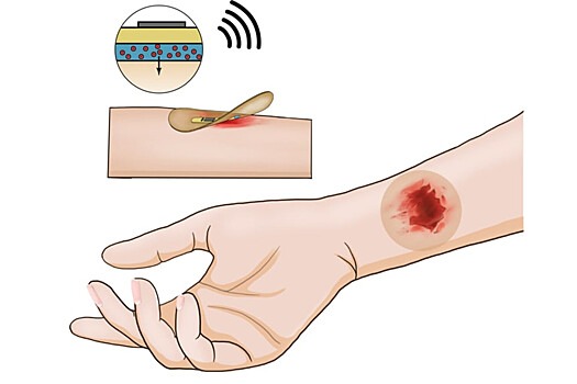 Американские ученые разработали пластырь для безболезненных инъекций