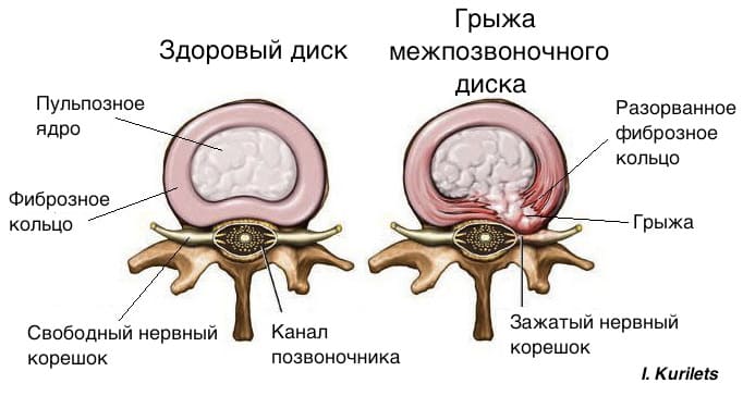 Грыжа диска: вместо операции попробуй это решение!