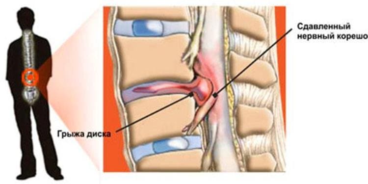 Грыжа диска: вместо операции попробуй это решение!
