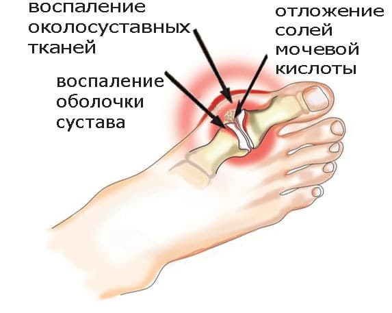 Как избежать подагры и опухолей? Удали мочевую кислоту из суставов