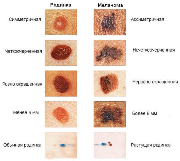 Опасные родинки