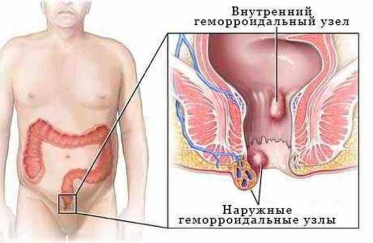 Варикоз и геморрой. 2 заболевания – одно решение