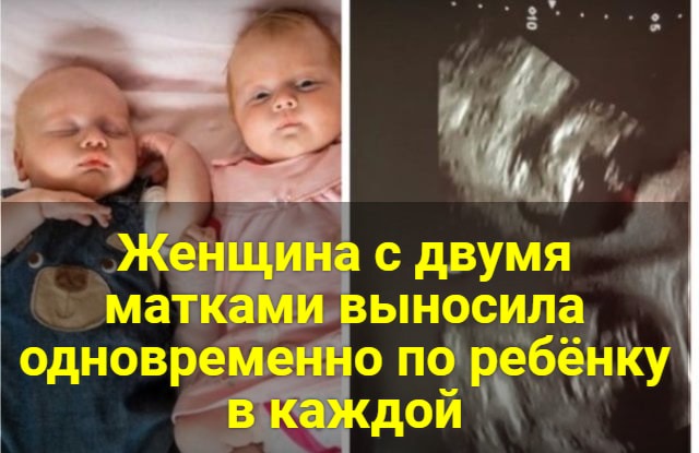 Женщина с двумя матками выносила одновременно по ребёнку в каждой