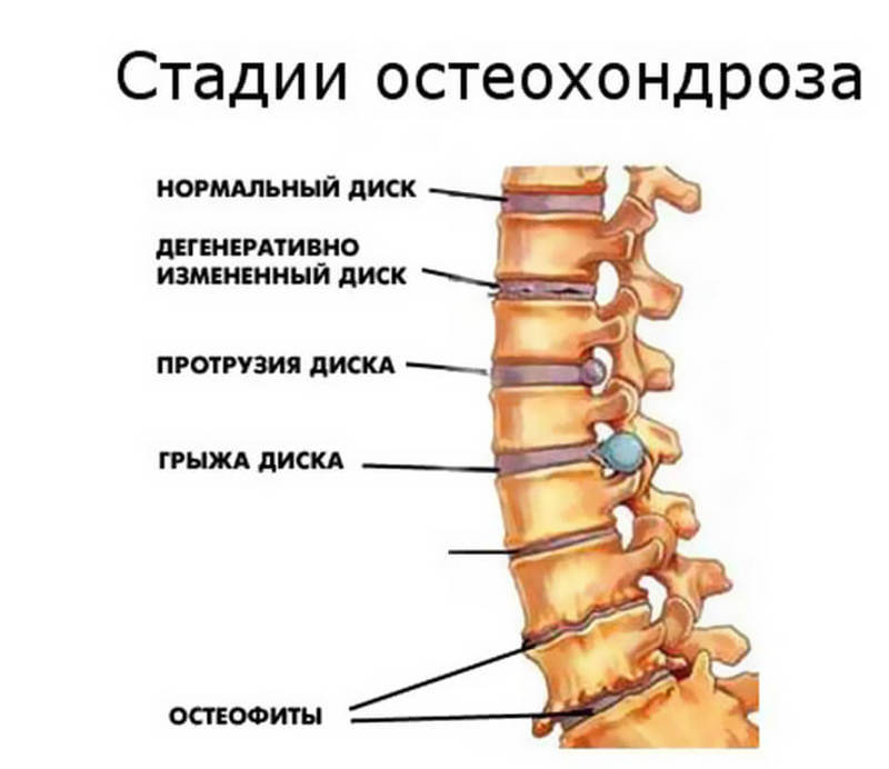 Остеохондроз — расплата за непонимание собственного организма3