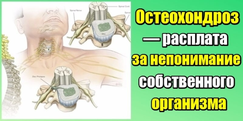 Остеохондроз — расплата за непонимание собственного организма